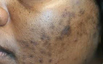 Close-up of acne with post-inflammatory hyperpigmentation on Black skin.