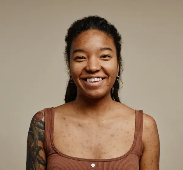 Acne and Eczema